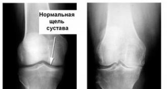 Рентген коленного сустава: показания и противопоказания, норма и патология Как выглядит здоровый коленный сустав рентгене
